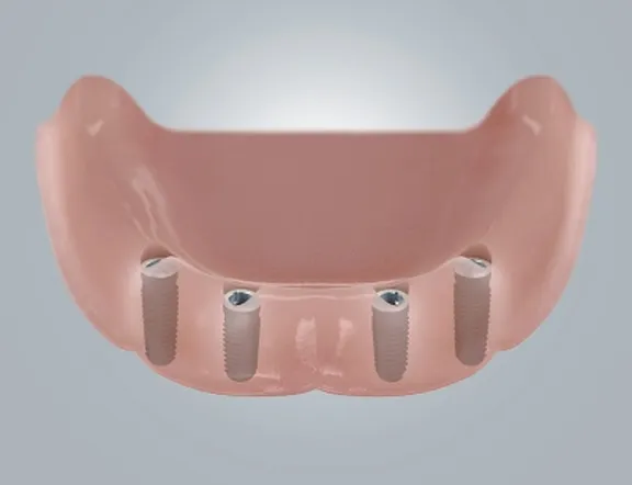 400x307-towidth-100-d_zahnloser_uk_2_mit_implantaten.jpg
